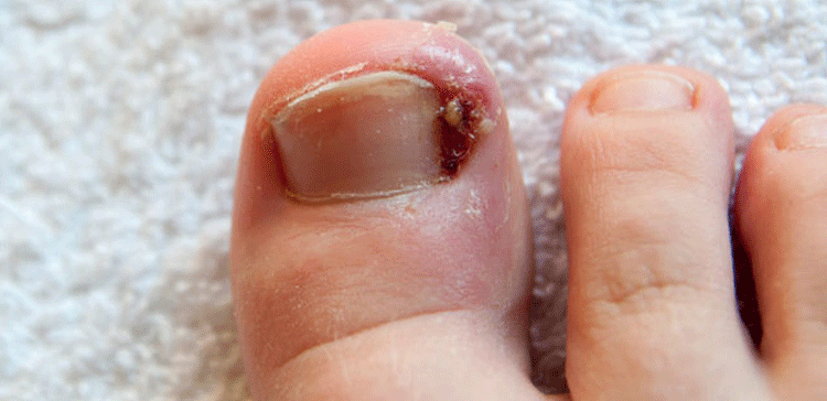 پیر کے ناخن گوشت میں دھنستے ہیں تو گھریلو نسخوں کا استعمال کریں