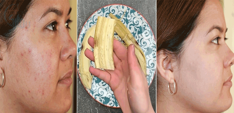 صرف 5 دن کیلے کا چھلکا اس طرح استعمال کریں اور کمال دیکھیں