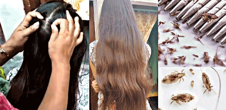 شادی سے پہلے سر صاف کرلیں تو بہتر ہے۔۔۔جوؤں سے نجات کیسے حاصل ہو؟