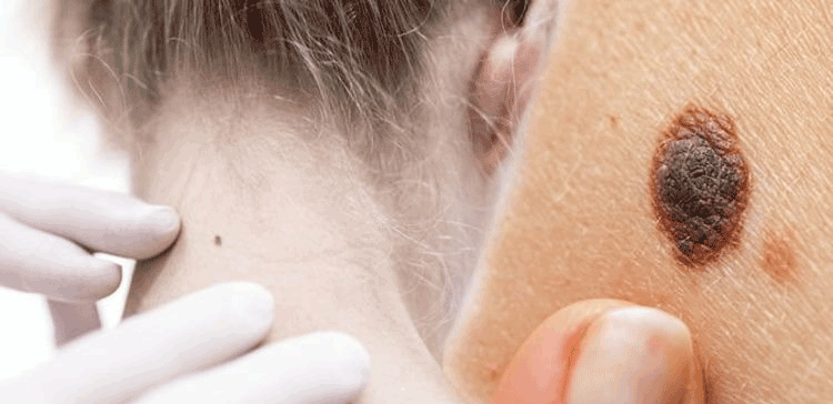 اگر آپ کے جسم پر بھی ایسا تل ہے تو جانیے یہ کس خطرناک بیماری کی نشاندہی کرتا ہے؟