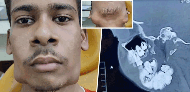 ایسا نوجوان جس کے منہ میں ایک دو نہیں پورے پچاس دانت زیادہ