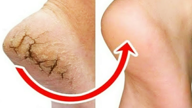 ایڑیاں کیوں پھٹتی ہیں؟ پھٹی ہوئی ایڑیوں کا علاج گھر پر ہی کریں اور انہیں خوبصورت بنائیں