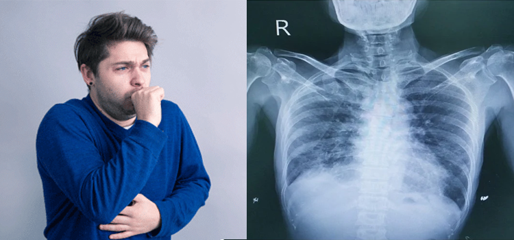 خشک کھانسی کس بیماری کی علامت ہے اور ILD کیا ہے؟ نظرانداز کرنا خطرناک ہوسکتا ہے