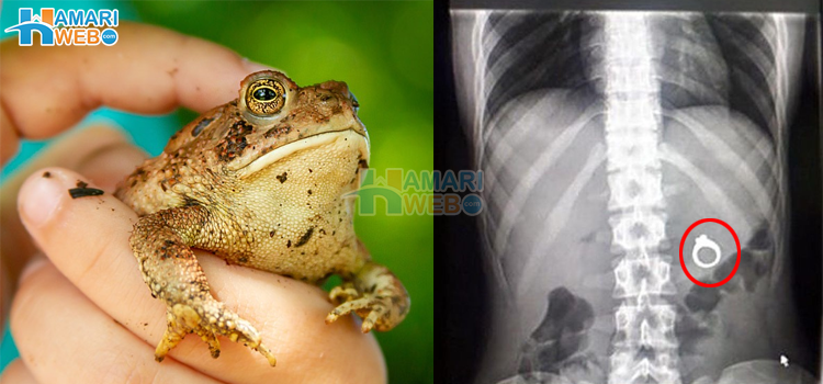 زندہ مینڈک سے لے کر کانچ کی بوتل تک، کچھ ایسی اشیا جو انسانوں کے پیٹ سے نکالی گئیں