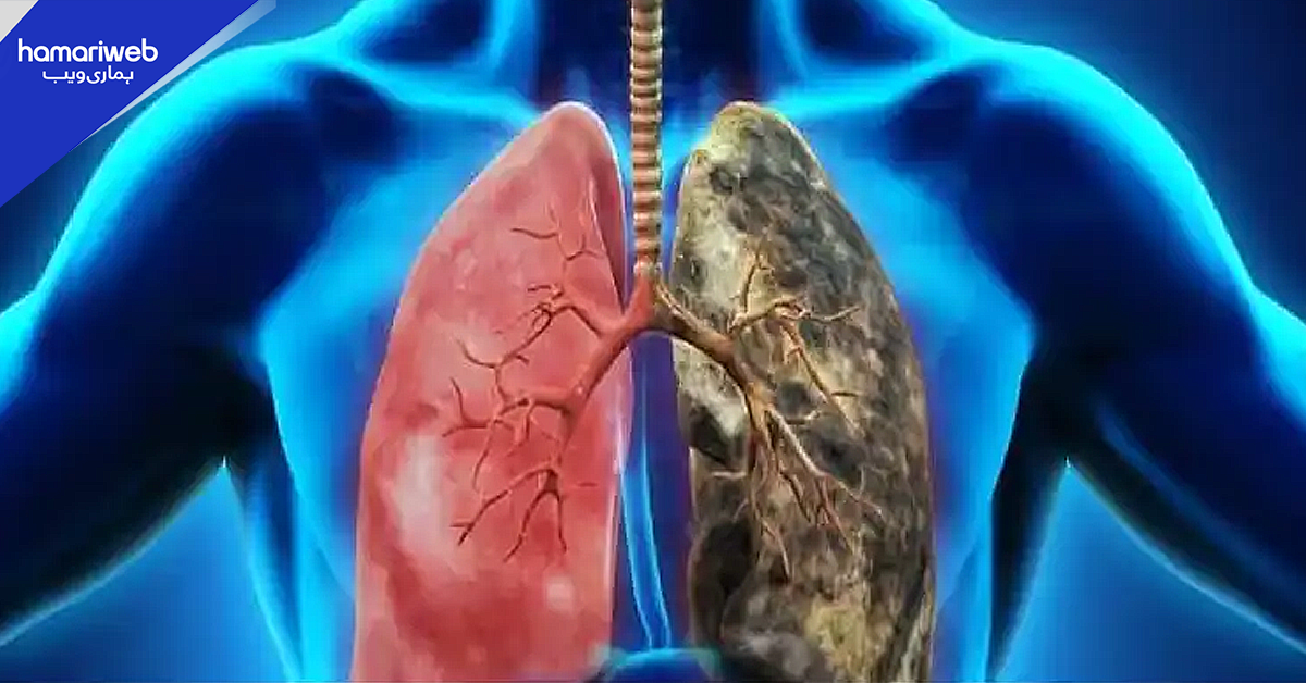 ادرک سانس کے انفیکشن کے خلاف مددگار، پھیپھڑوں کی صفائی کیلیے خاص نسخے