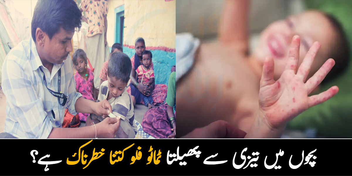 بچوں میں تیزی سے پھیلتا ٹماٹو فلو بڑوں کو بھی شدید بیمار کرسکتا ہے۔۔ یہ وائرس کتنا خطرناک ہے؟ 