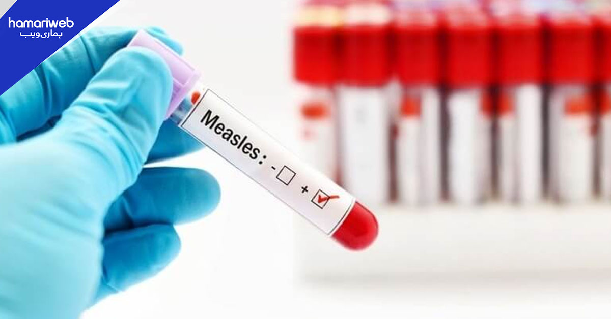 گھوٹکی میں خسرہ کا وار: ایک خاندان کے دو معصوم بچے جاں بحق