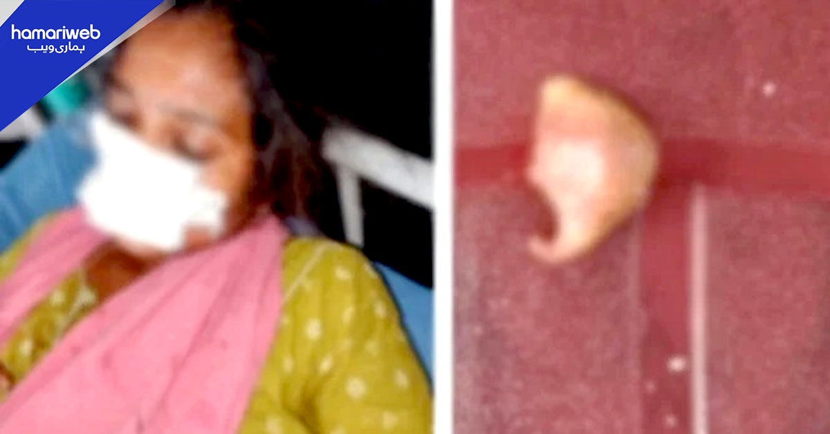 میکے سے واپس نہ آنے پر شوہر نے بیوی پر حملہ کر دیا، ناک کا حصہ کاٹ دیا