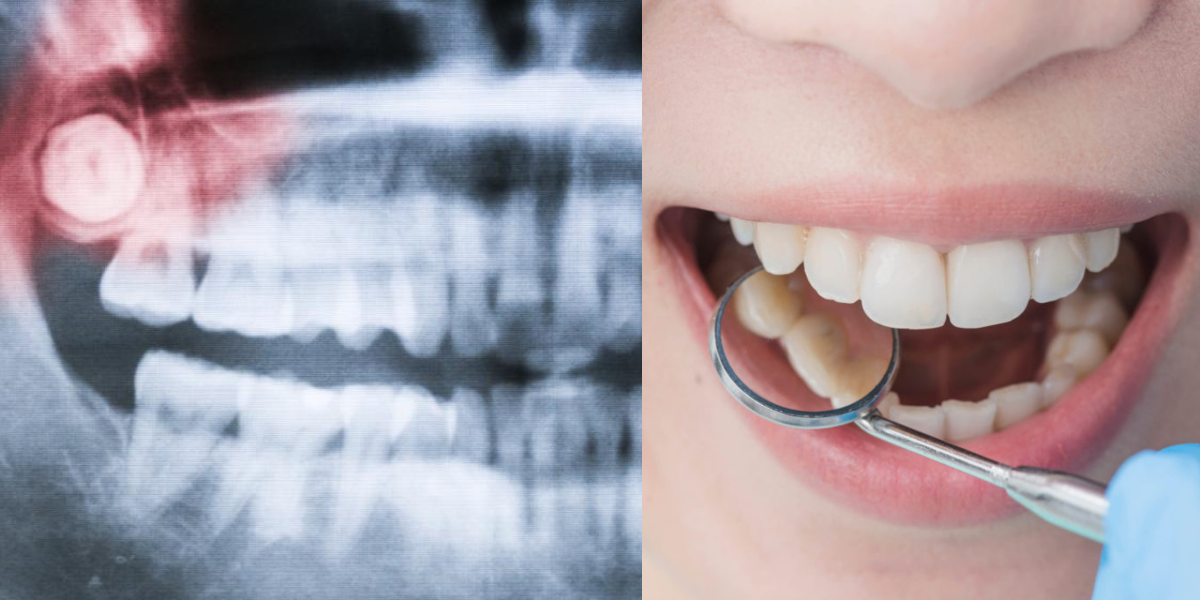 عقل داڑھ کو عقل داڑھ کیوں کہتے ہیں ۔۔۔۔۔ کیا اس کا تعلق ہماری عقل سے ہوتا ہے؟