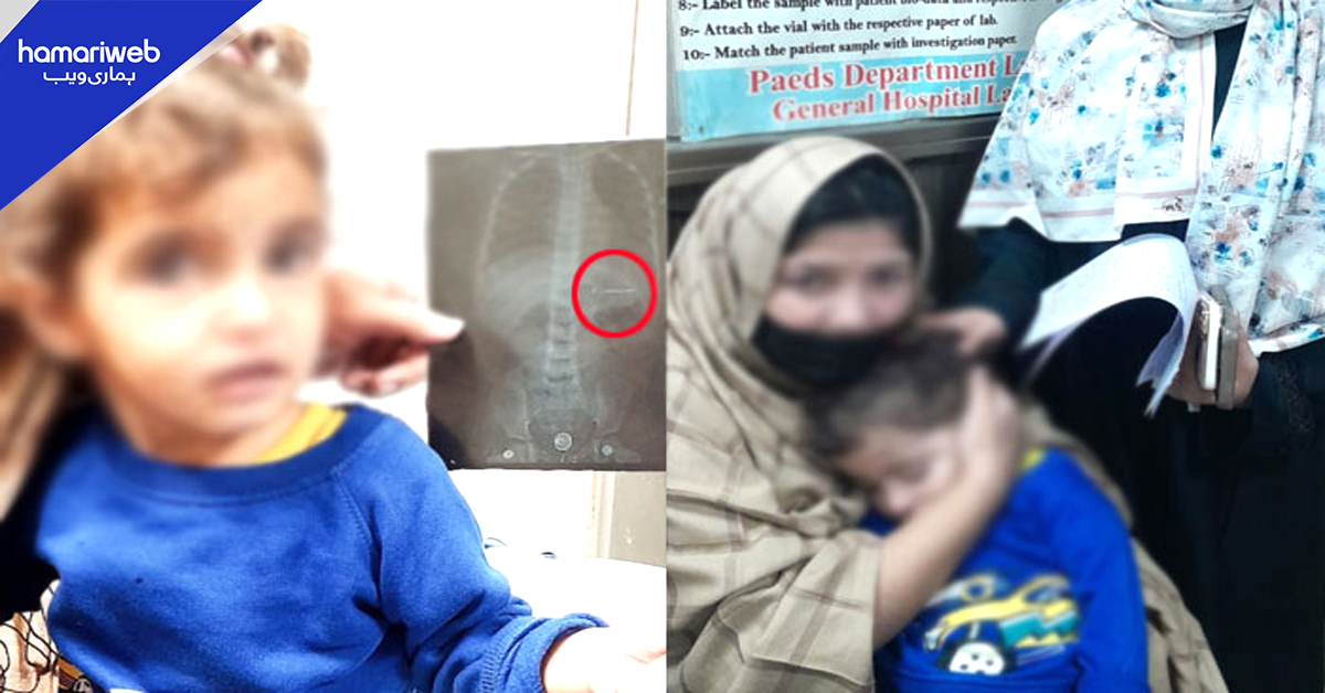 3 سالہ بچی کے معدے میں ہیئر پن کیسے پہنچی؟ ڈاکٹروں کا اہم کارنامہ جس نے معصوم کی جان بچالی