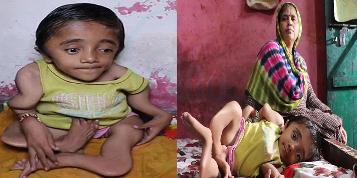 نازک لڑکا جسے چھونے سے اس کی ہڈیاں ٹوٹ جاتی ہیں۔۔۔100 ٹوٹی ہوئی ہڈیوں والا یہ بچہ کس خطرناک بیماری میں مبتلا ہے؟