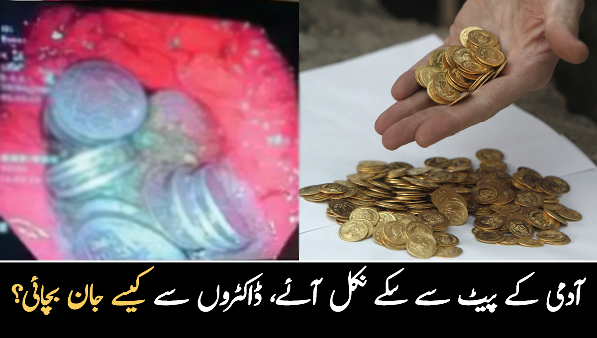 آدمی کے پیٹ سے ڈھیروں سکے نکل آئے۔۔ شہری کی حالت بگڑنے کے بعد ڈاکٹروں نے اس کے پیٹ سے سکے کیسے نکالے؟