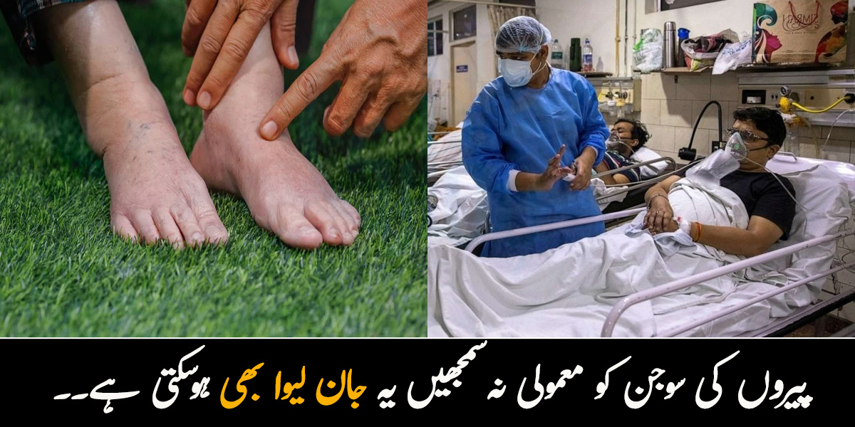 پیروں کی سوجن کو معمولی نہ سمجھیں یہ جان لیوا بھی ہوسکتی ہے۔۔ جانیے معمولی دکھنے والی پیر کی سوجن کن خطرناک بیماریوں کی علامت بن سکتی ہے؟