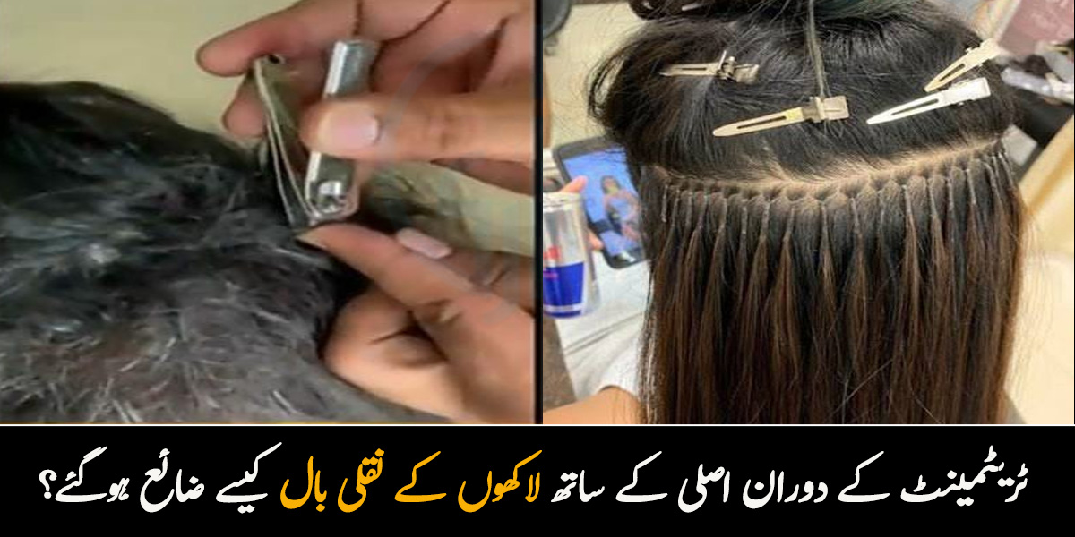 بال ہی اکھاڑ دئیے! جانیے ٹریٹمینٹ کے دوران اصلی کے ساتھ لاکھوں کے نقلی بال کیسے  ضائع ہوگئے؟