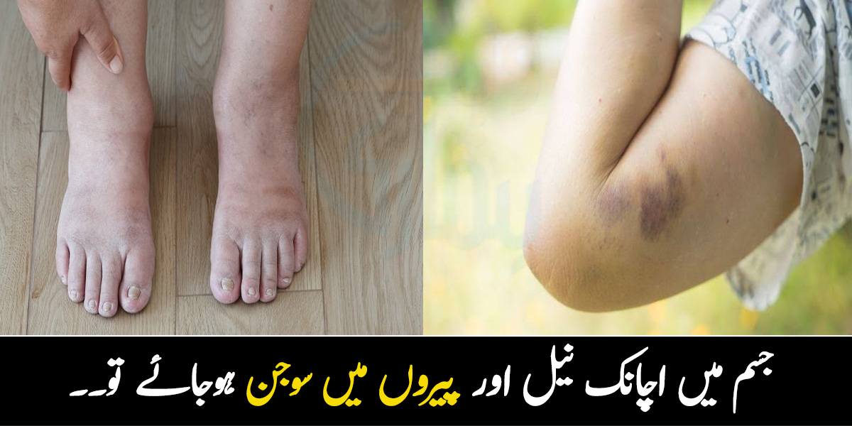 جسم میں اچانک نیل اور پیروں میں سوجن ہوجائے تو۔۔ چند ایسی نشانیاں جو آپ کی صحت کی گڑبڑ کے بارے میں بتاتی ہیں