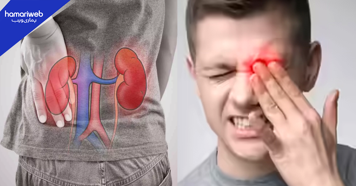 آنکھوں میں سوجن کس بیماری کی علامت ہے؟ ڈائیلاسز سے بچنا چاہتے ہیں تو ماہرین کی بتائی ان نشانیوں کو کبھی نظر انداز نہ کریں