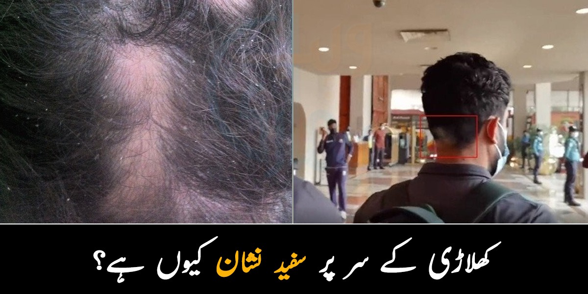 کھلاڑی کے سر پر سفید نشان کیوں ہے؟ سوشل میڈیا پر نئی بحث چھڑ گئی 