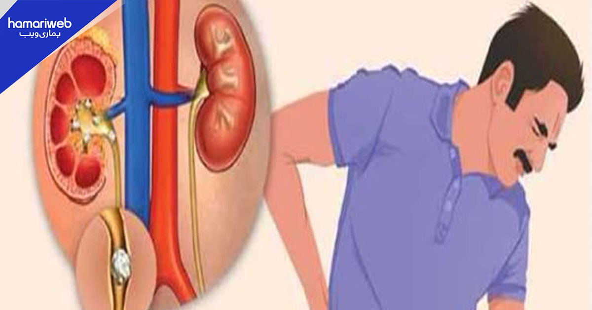 نوجوانوں میں گردے کی پتھری کے کیسز میں اضافہ، ماہرین نے وجوہات بتا دیں