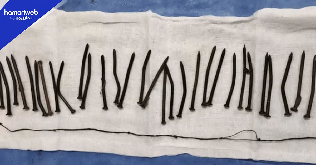 مصر میں حیران کن واقعہ، ڈاکٹروں نے مریضہ کے معدے سے 34 لوہے کی کیلیں نکال لیں