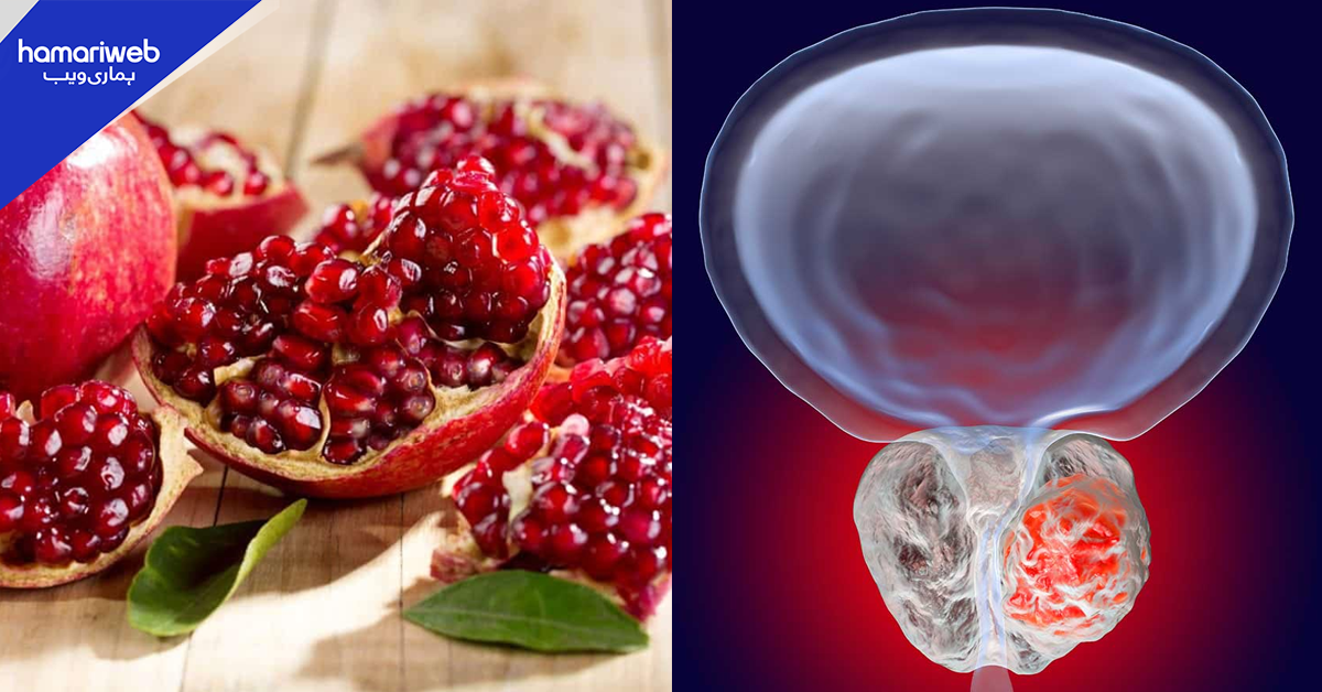 پروسٹیٹ کینسر : صرف ایک انار  سے اس بیماری کا علاج کیسے ممکن؟