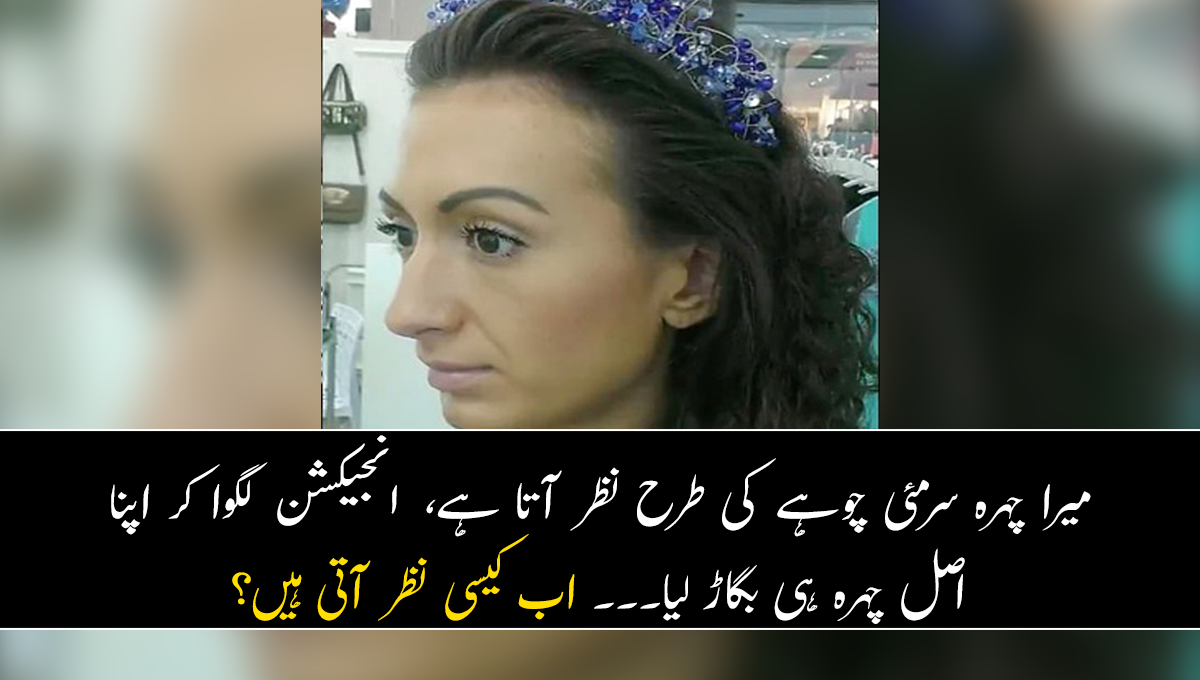    میرا چہرہ سرمئی چوہے کی طرح نظر آتا ہے، خاتون نے انجیکشن لگوا کر اپنا اصل چہرہ ہی بگاڑ لیا۔۔۔ اب کیسی نظر آتی ہیں؟