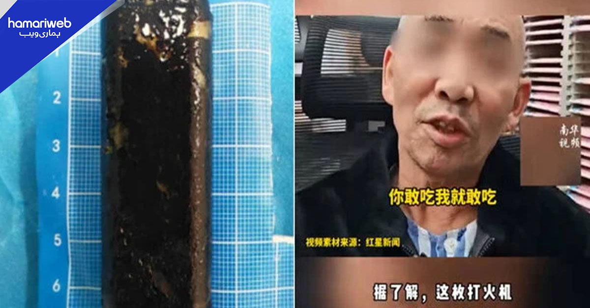 چین میں تین دہائی بعد معدے سے نکلا ’ لائٹر‘۔۔۔ ڈاکٹر بھی حیران رہ گئے!