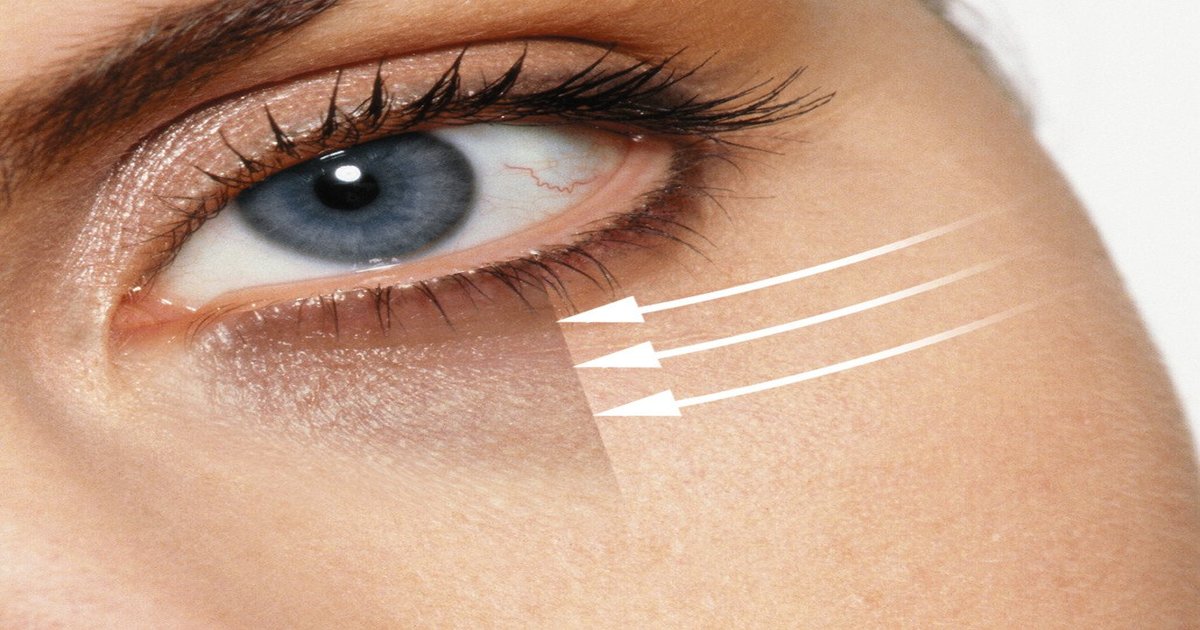 آنکھوں کے گرد سیاہ حلقے ہوگئے ہیں تو انھیں بتائے گئے طریقے کریں ختم