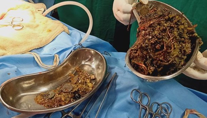 بھارتی خاتون نے زیورات پہننے کے بجائے نگل لیے