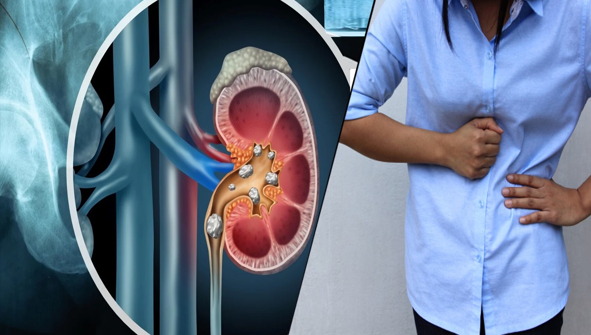 گردے کی پتھری کا علاج کیسے کیا جائے جانیں ماہرین کی رائے، ابھی آزمائیں اور جلد قابو پائیں