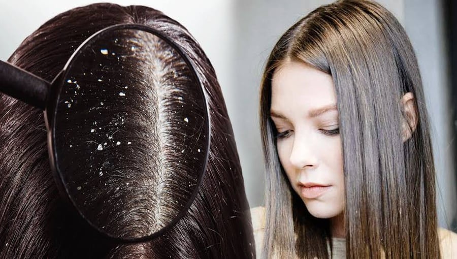 اگر آپ کے بالوں میں بھی خشکی ہوگئی ہے تو اس کو فوری طور پر کنٹرول کرنے کے لیے یہ آسان گھریلو ٹپ آزمائیں اور بالوں کو مضبوط، سلکی اور خشکی سے پاک بنائیں
