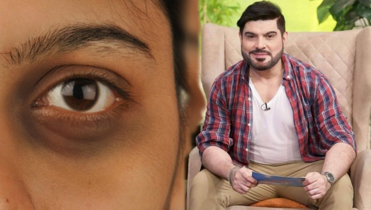 ڈاکٹر خُرم نے بتایا حلقوں کے علاج کا آسان طریقہ جس سے ہوں چند ہی دن میں آپ کے حلقے غائب