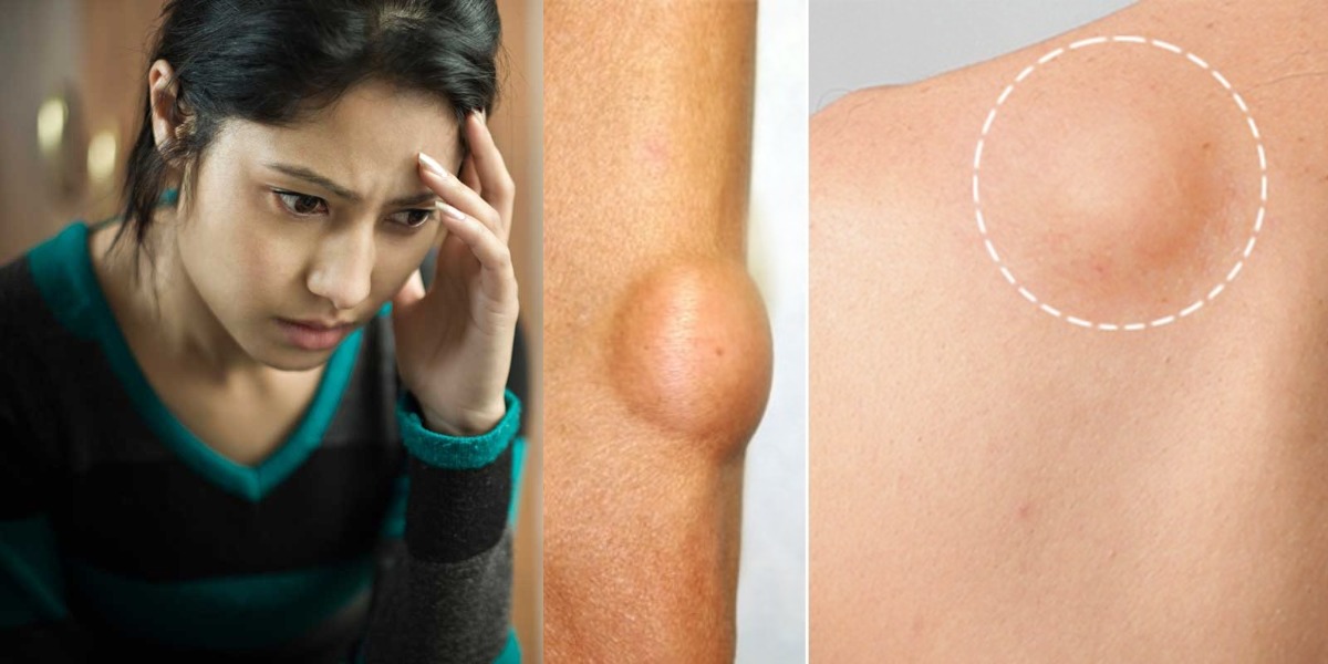 کیا آپ کے بھی جسم کے مختلف حصوں میں گٹھلیاں نکل آتی ہیں؟ جانیئے اس کو ختم کرنے کا آسان طریقہ