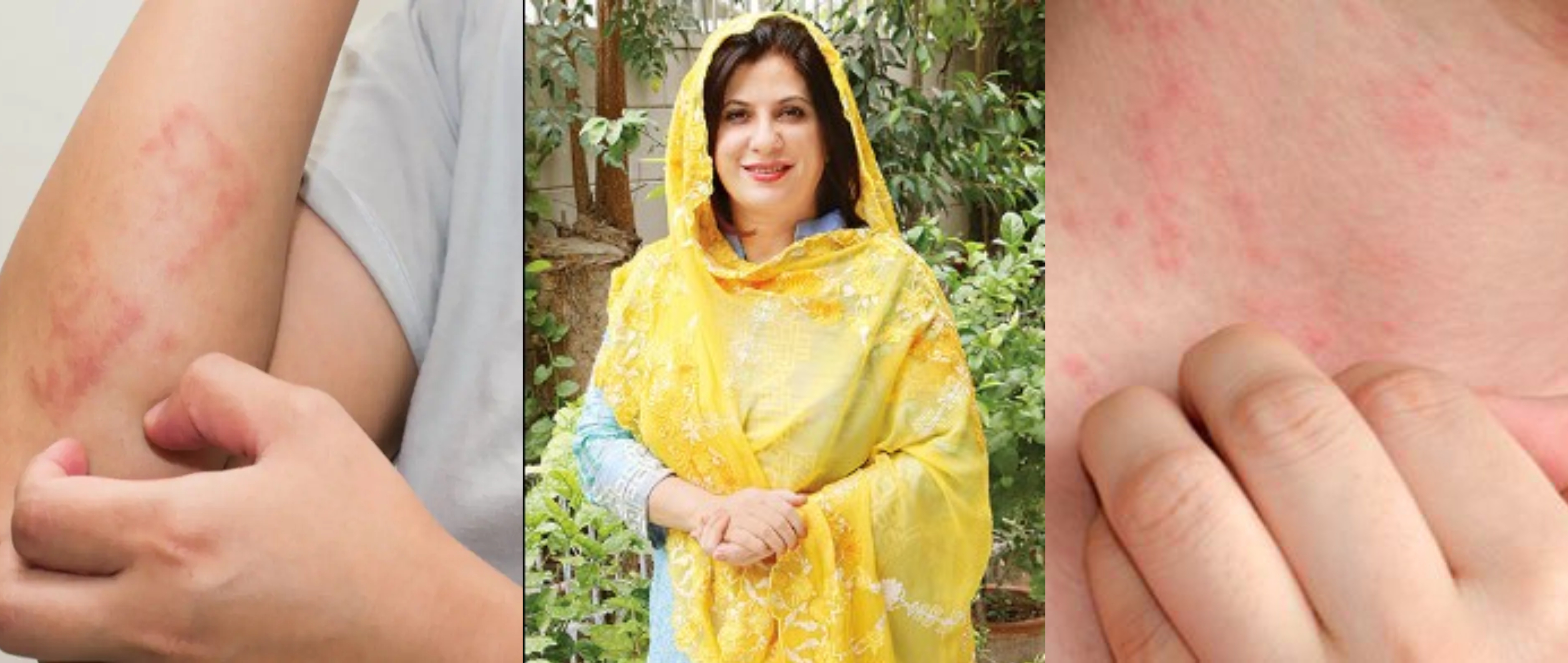 گرمی دانوں کا کریں فوری خاتمہ ڈاکٹر بلقیس کی بتائی ہوئی ایسی گھریلو ٹپ سے جو بچائے آپ کے ہزاروں روپے