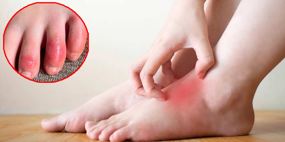 نئی چپّل یا موزوں کی وجہ سے پاؤں میں الرجی ہو گئی ہے اور بہت خارش ہو رہی ہے تو۔۔۔ جانیں اس میں فوری آرام لانے کی چند آسان ٹپس