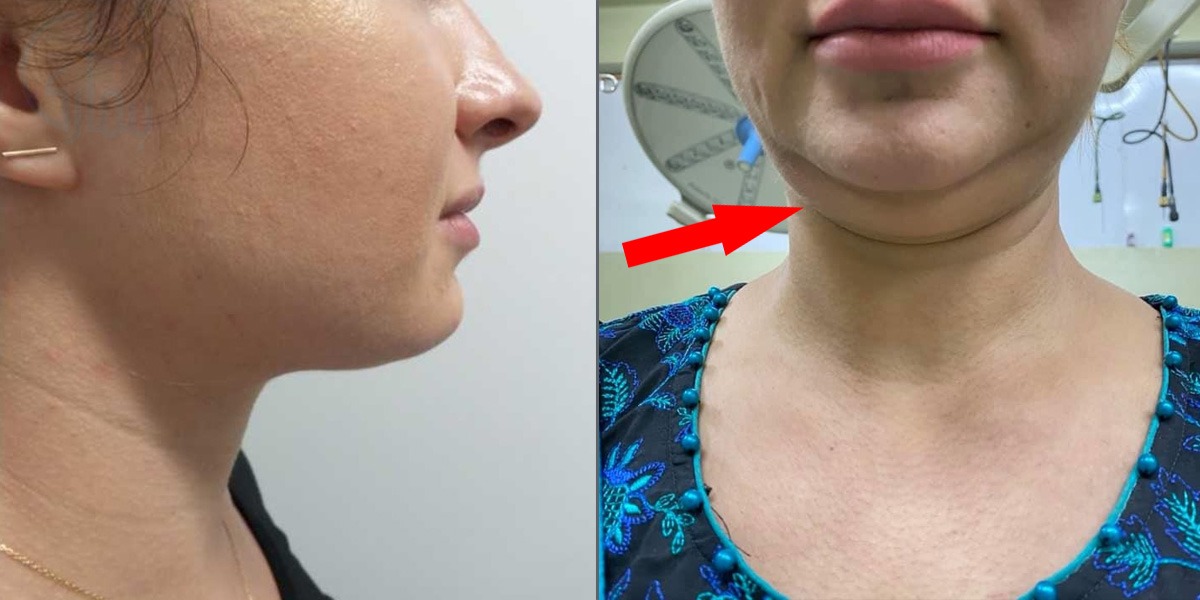 ڈبل چن کو سرجری کے بغیر کیسے ختم کیا جا سکتا ہے؟ جانیئے ڈاکٹر شائستہ لودھی کا بتایا ہوا ٹریٹمنٹ