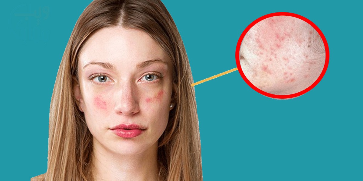 آپ کی جلد بہت حساس ہے اور کچھ بھی استعمال کرنے سے فوری سائیڈ ایفیکٹ ہو جاتا ہے؟ تو جانیں اس حساس جلد کا خیال رکھنے کے چند آسان طریقے