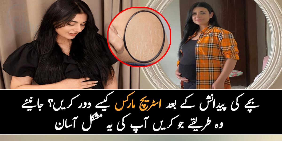 بچے کی پیدائش کے بعد اسٹریچ مارکس کیسے دور کریں؟ جانیئے وہ طریقے جو کریں آپ کی یہ مشکل آسان
