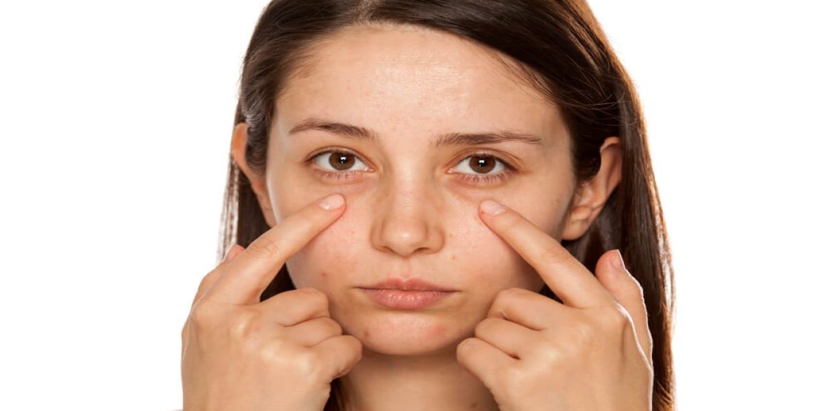 آنکھوں کے گرد سیاہ حلقوں سے نجات میں مددگار طریقے