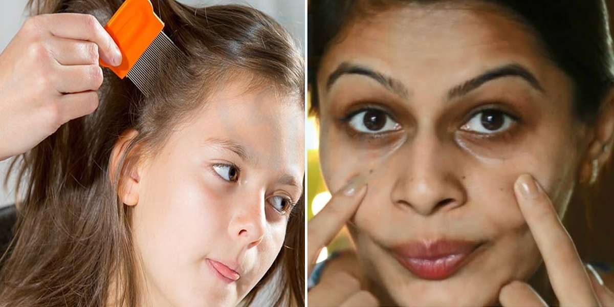 آنکھوں کے حلقوں کو دور کرنا ہو یا بچیوں کے سروں سے جوئیں ۔۔ جانیے 2 ایسی ٹپس جو روزمرہ کی زندگی میں آپ کے بھی کام آسکتی ہیں