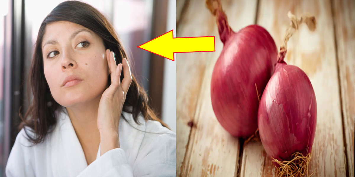 اگر آپ کے بھی چہرے پر مسے ہیں تو جانیے پیاز سے کیسے ان کو کمزور بنایا جا سکتا ہے؟ جانیے کچھ مفید گھریلو ٹپس