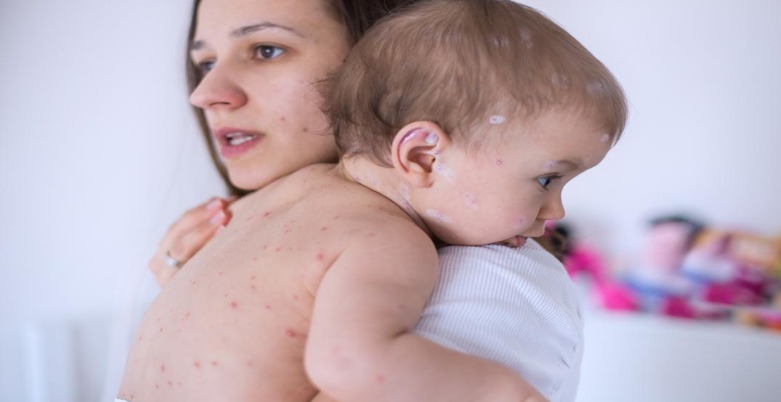 بچوں میں ہیٹ ریش یا گرمی دانے؟ یہ کیا ہے، اس کی وجوہات، اور اس سے کیسے بچا جا سکتا ہے؟