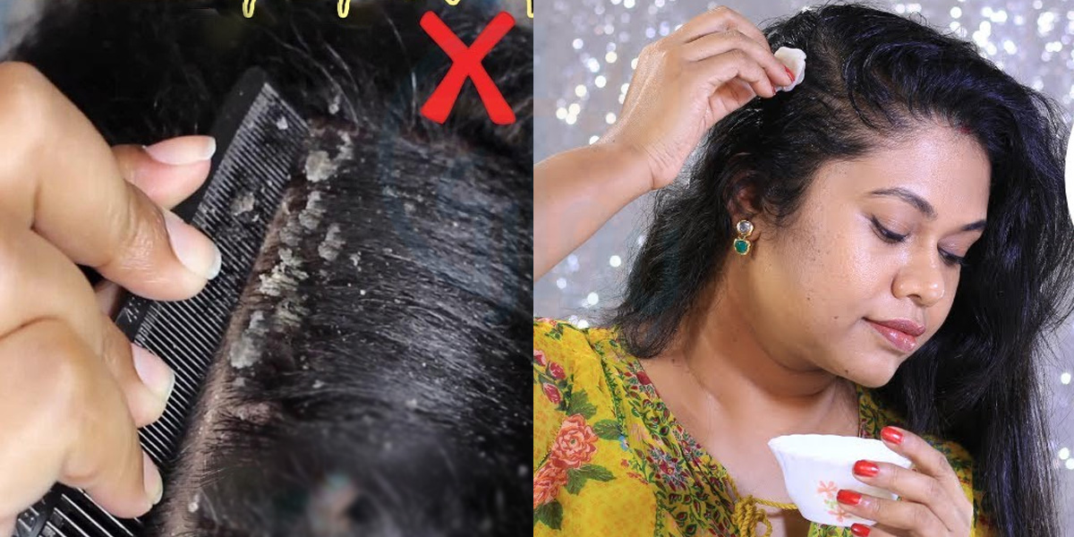 میرے بالوں میں خُشکی سے زخم ہوگئے تھے ۔۔ بالوں کو خشکی کیسے ختم کریں؟ چند ایسے طریقے جو خشکی کو ختم کرنے میں مدد دیتے ہیں