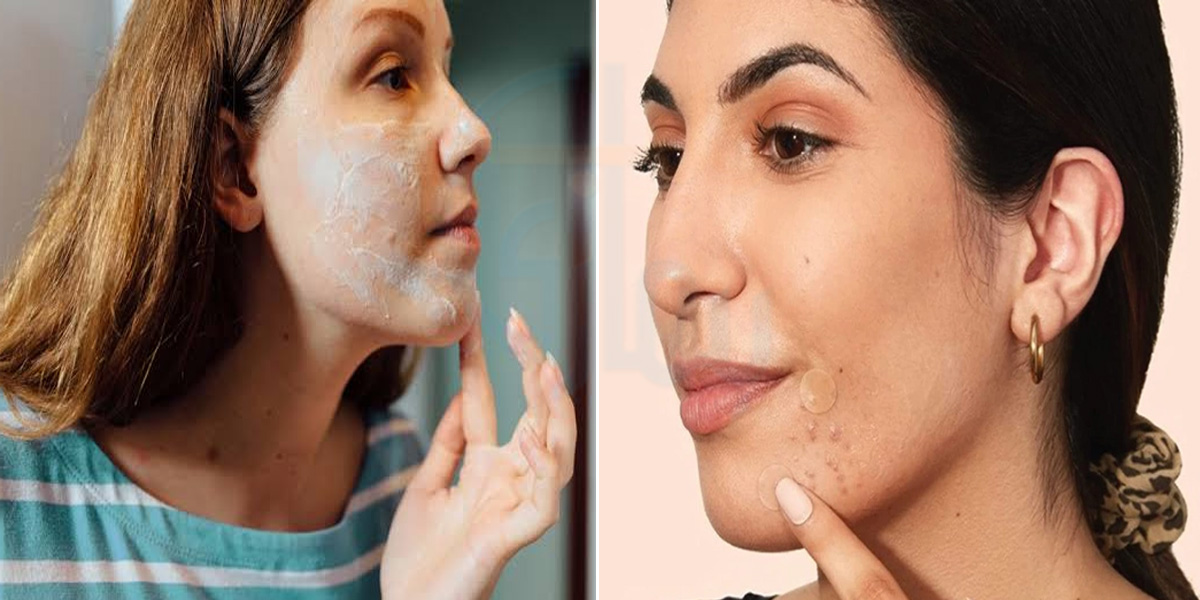 اگر آپ بھی چہرے کے دانوں کو پھوڑتی ہیں تو ٹہریں ۔۔ چند ایسی عادتیں جو تیزی سے آپکا چہرہ خراب کرتی ہیں