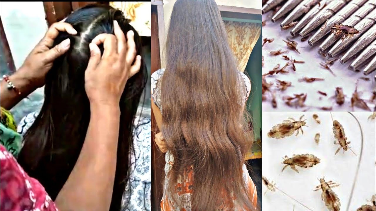 ہر وقت سر پر ڈوپٹہ نہ رکھیں کیونکہ؟ جانیئے جوؤں سے چھٹکارہ حاصل کرنے کا بہترین طریقہ آج ہی آزمائیں اور اس مصیبت سے جان چھڑائیں