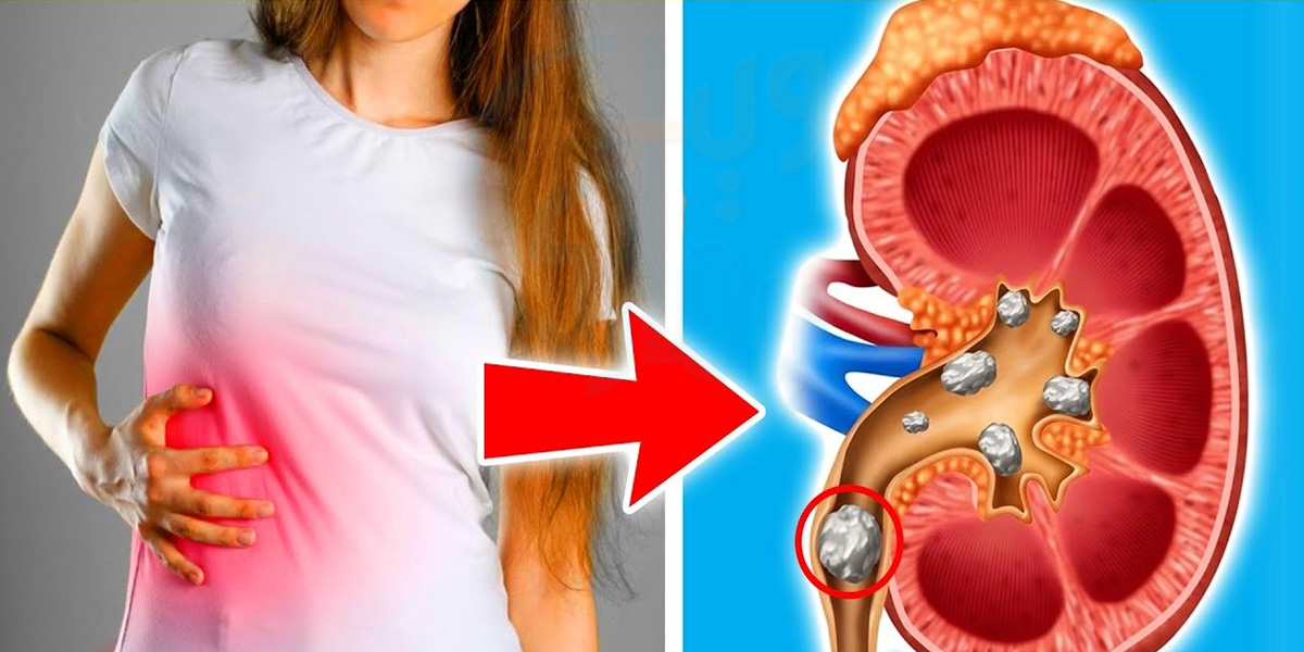 گردے کی پتھری کو ٹھیک کرنے میں کون سی چیزیں مددگار ثابت ہوسکتی ہیں ؟ جانیئے کچھ ایسے طریقے جس سے آپ وقت رہتے گردے کے خطرناک بیماری سے بچ سکتے ہیں