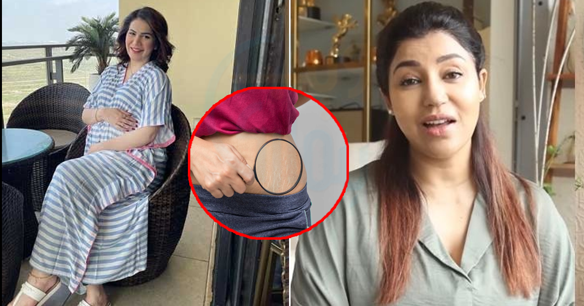 کیا آپ بھی جلد پر پڑنے والے اسٹریچ مارکس ختم کرنا چاہتے ہیں؟ جانئے بنا کریم کے اسے دور کرنے کے کچھ آسان طریقے