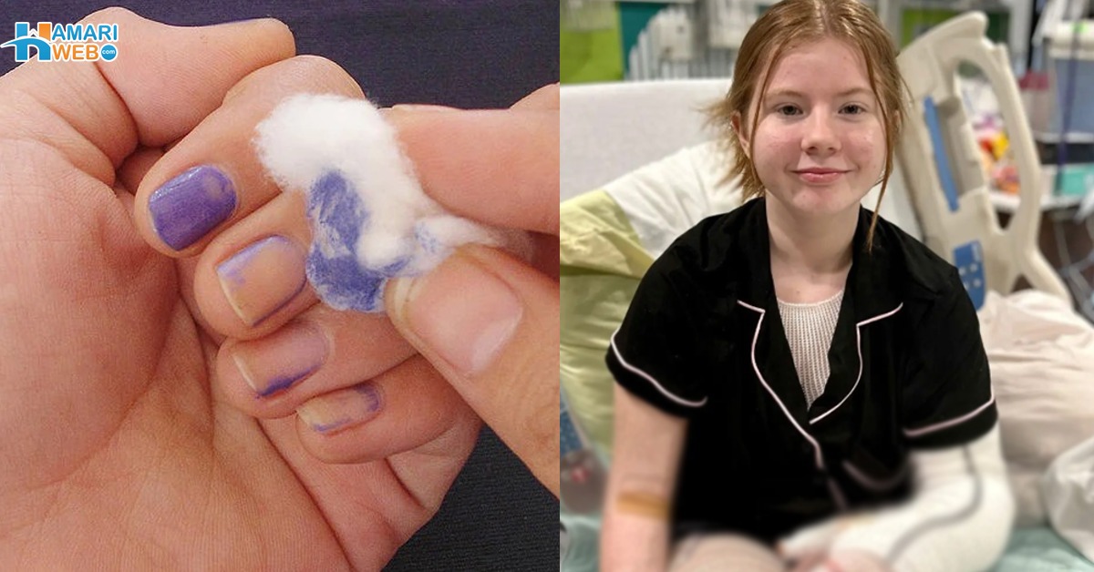 بوتل میرے ہاتھ میں پھٹ گئی اور ۔۔ نیل پالش صاف کرنے والی لڑکی کے ساتھ کیا ہوا جو آگ سے برُی طرح جھلس گئی؟