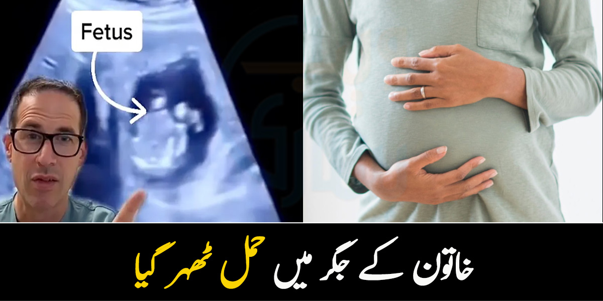پیٹ کی بجائے جگر میں حمل ٹہر گیا ۔۔ جانیئے خاتون کے ساتھ کیا واقعہ پیش آیا؟