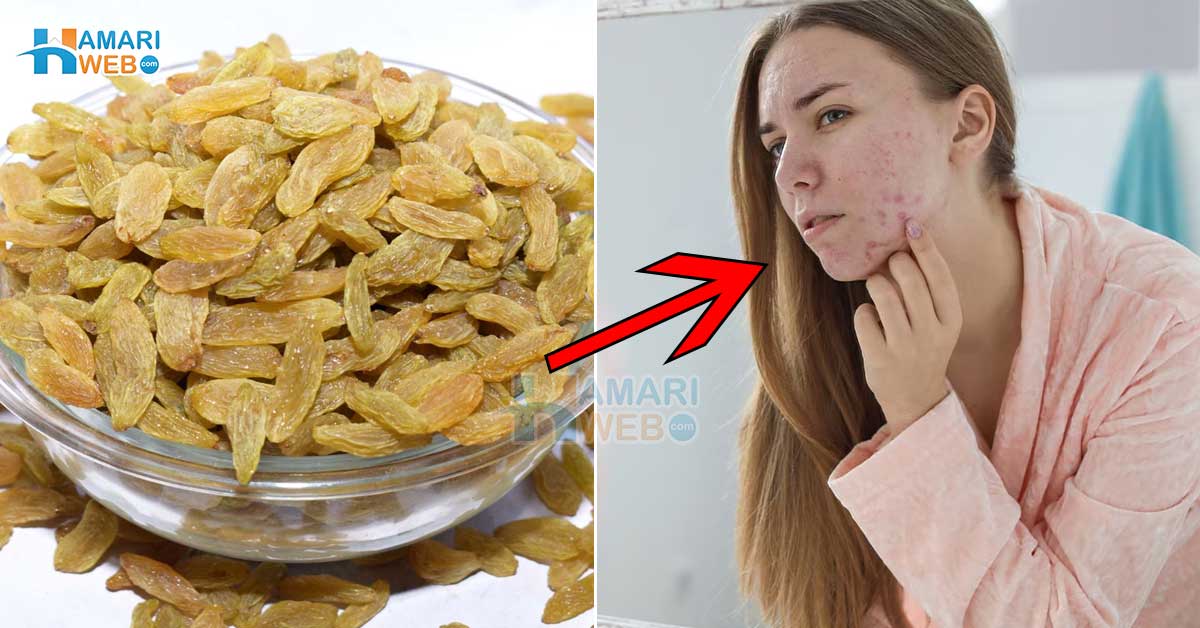 کشمش سے ایکنی غائب! کشمش کو پانی کے ساتھ اس طریقے سے ایک بار استعمال کریں اور جلد کو کیل مہاسوں سے پاک بنائیں