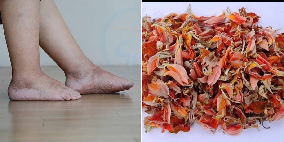 پیروں میں شدید درد ہے تو بس اسے ابال کر۔۔ ایسا نایاب پھول جس کے بارے میں بہت کم لوگ جانتے ہیں، جانیئے ٹیسو کے پھول کے حیرت انگیز فائدے